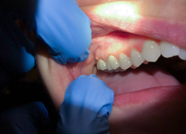 Best Chipped Tooth Repair Near Me  in USA